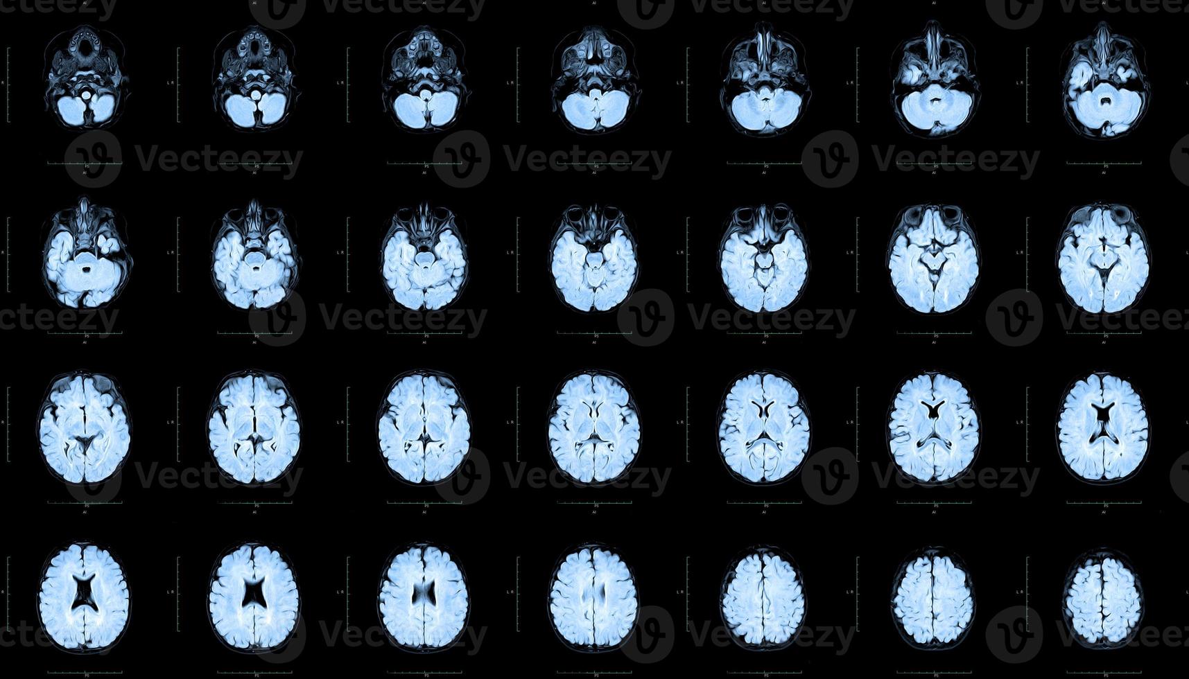 MRI of the skull and brain of a person with cerebral malformations, preliminary diagnosis, holoproencephaly, absence, agenesis of the transparent septum, one-year-old boy, top view. photo