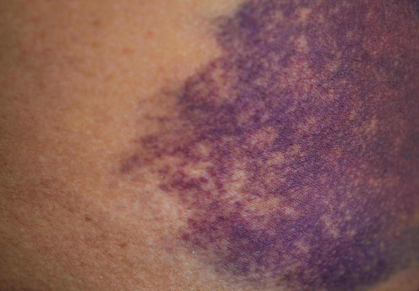 Bruise on the buttock skin injury from accident at home. photo