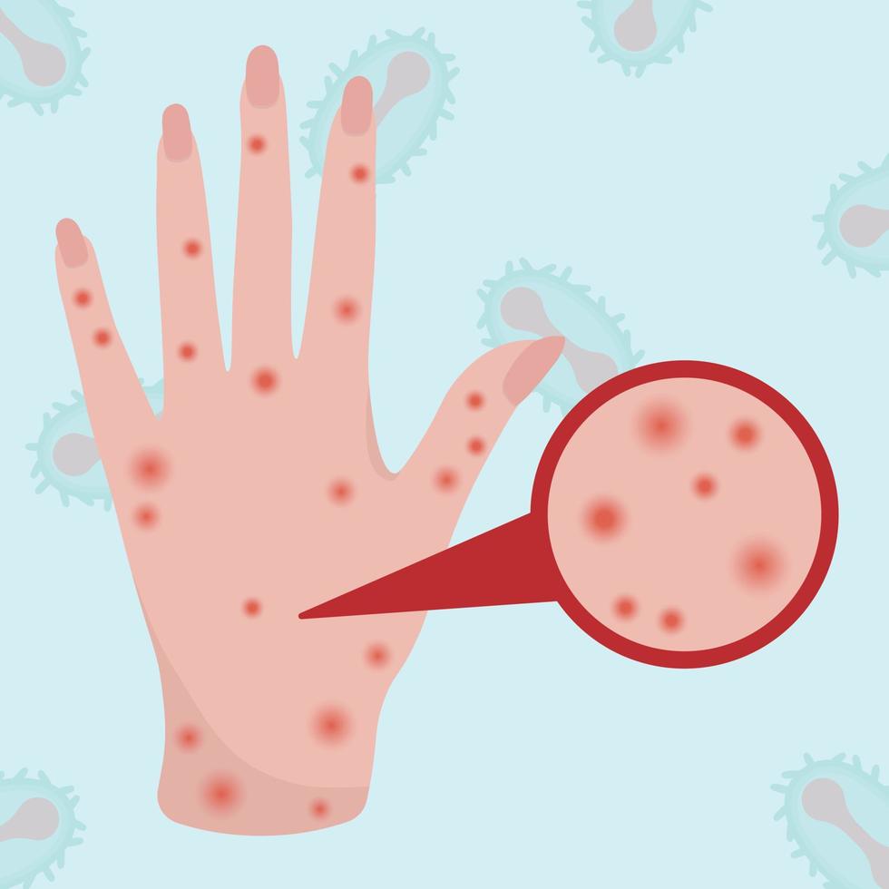 Smallpox virus. Vector illustration of smallpox virus. Monkeypox.