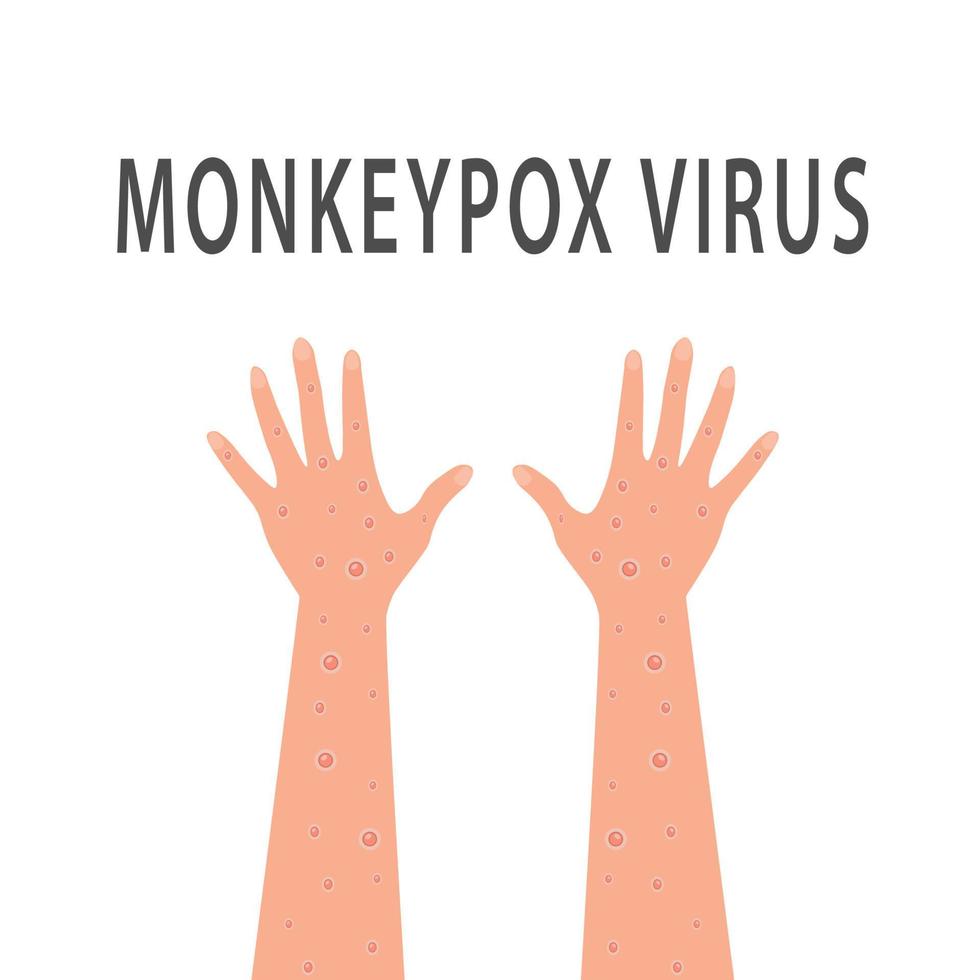 Symptoms of monkeypox vector