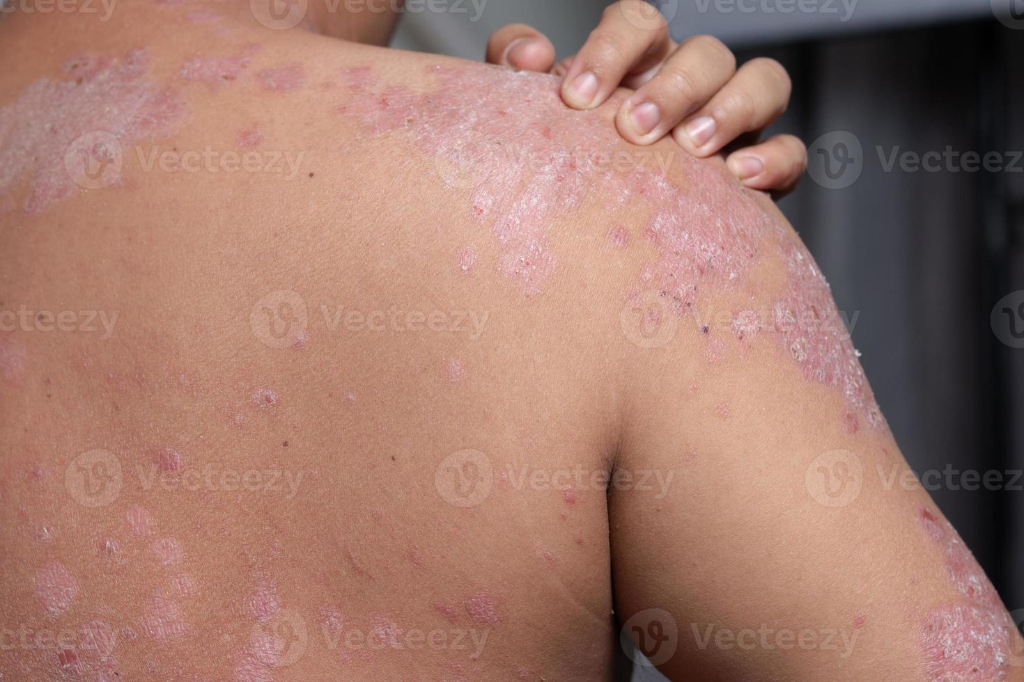Men are using his hands to scratch the shoulder ulcers photo