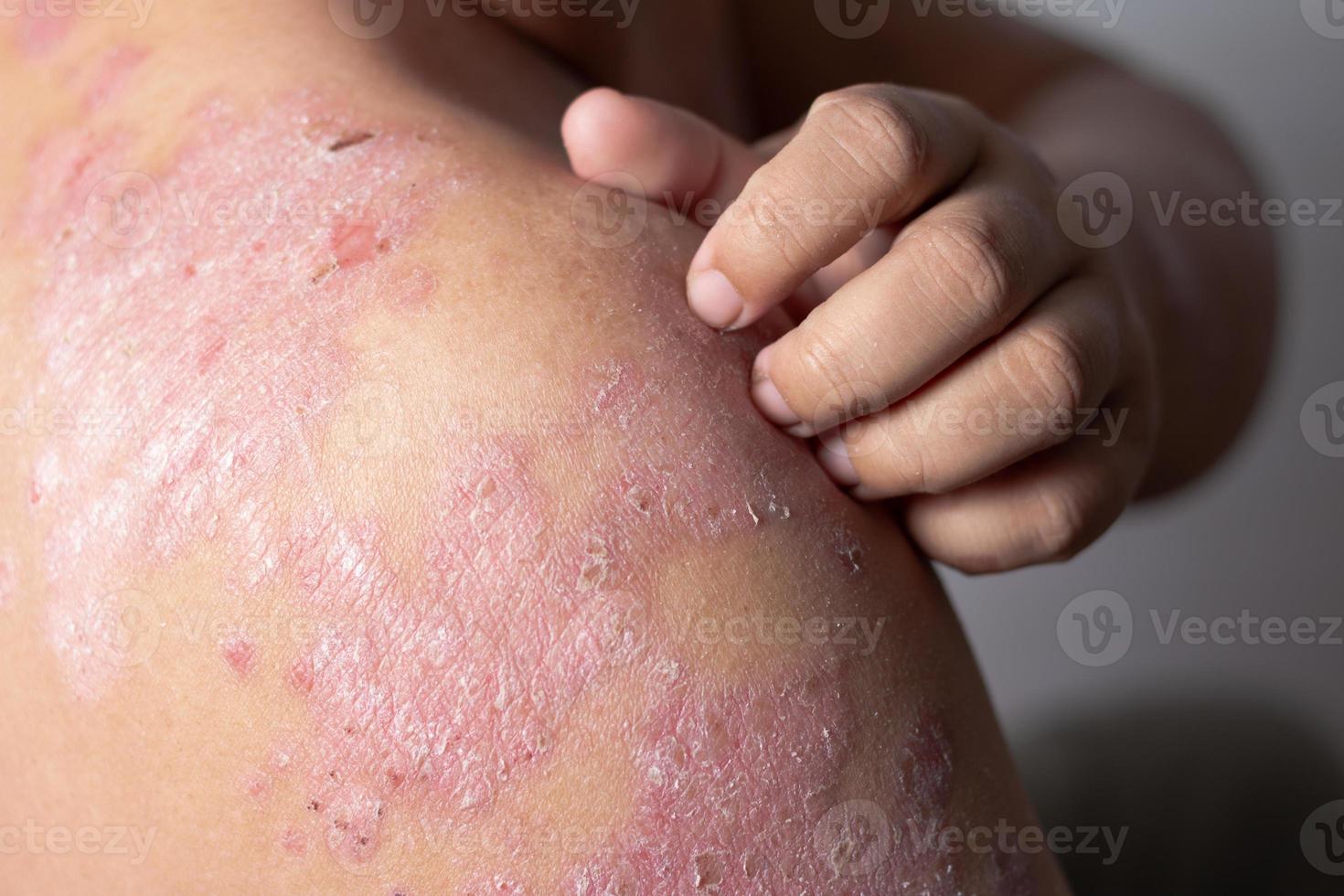 Men are using his hands to scratch the shoulder ulcers photo