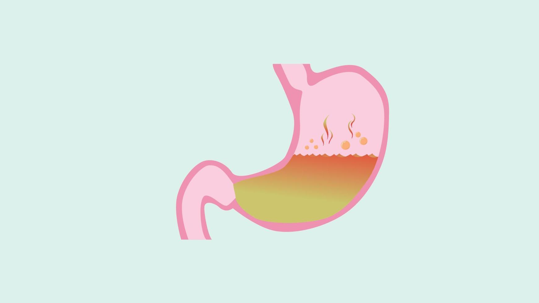 ilustración de un dolor de estómago de vector de estómago gerd