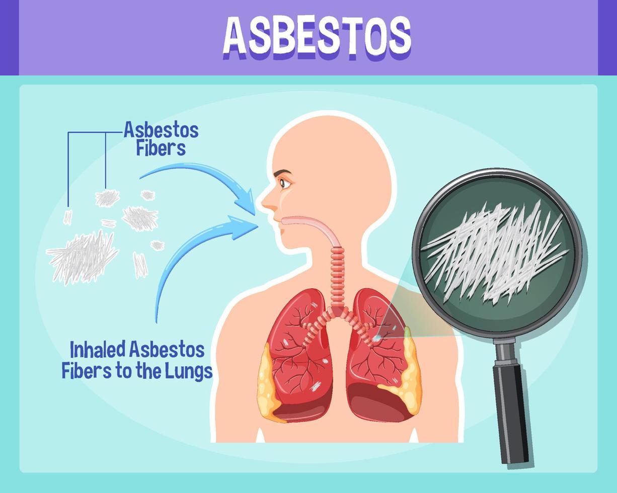 diagrama que muestra la asbestosis en los pulmones vector