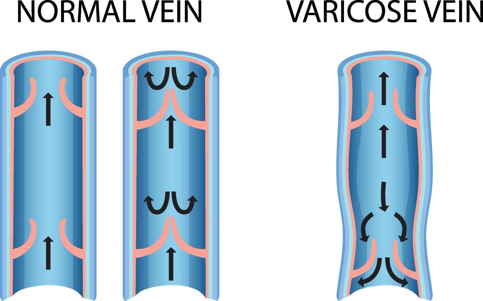 A comparison of normal vein with varicose vein vector