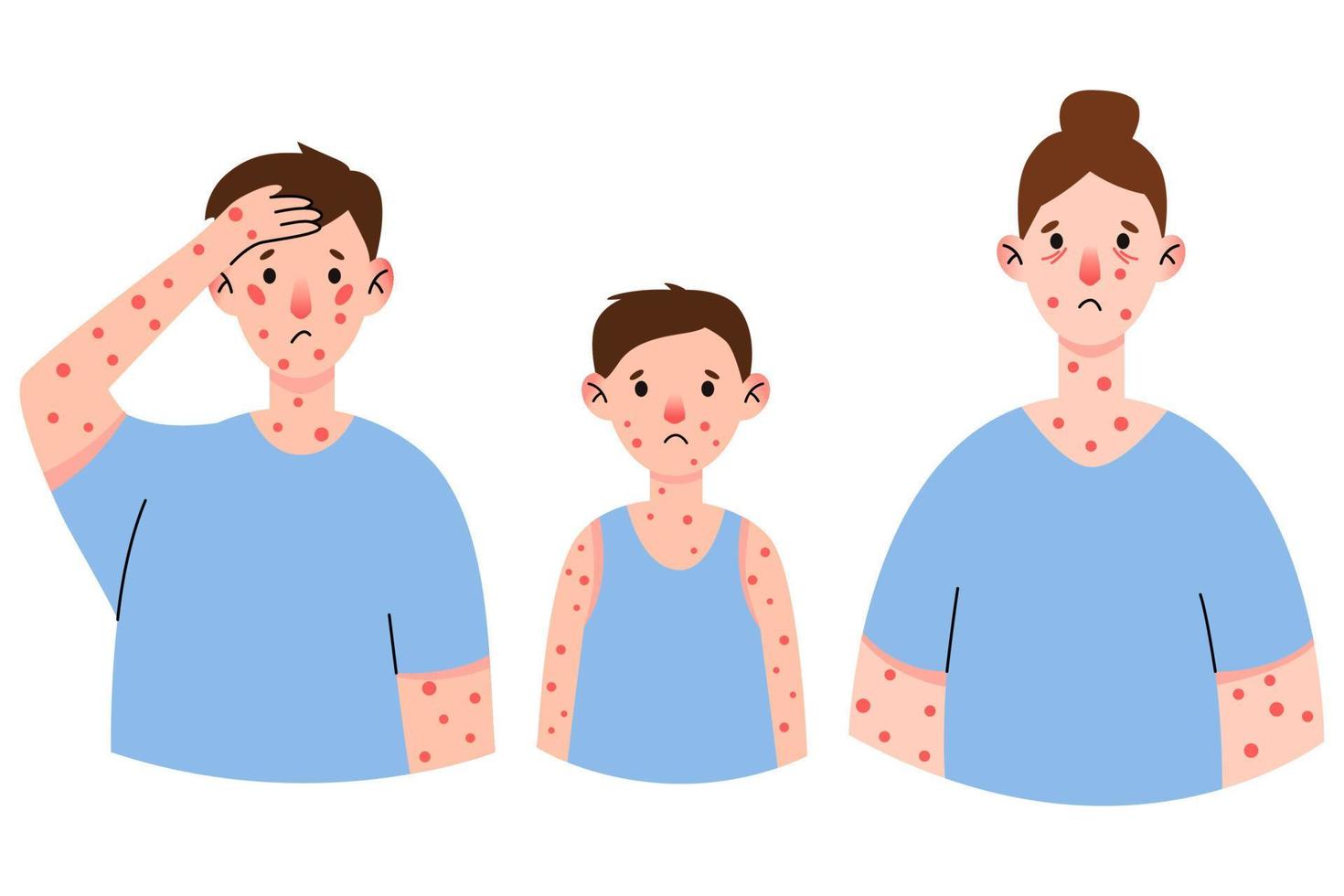 Set monkeypox virus symptom on patient with fever, headache, swollen lymph node, rashes on face, body and back, muscle aches. Vector flat isolated illustration for print.