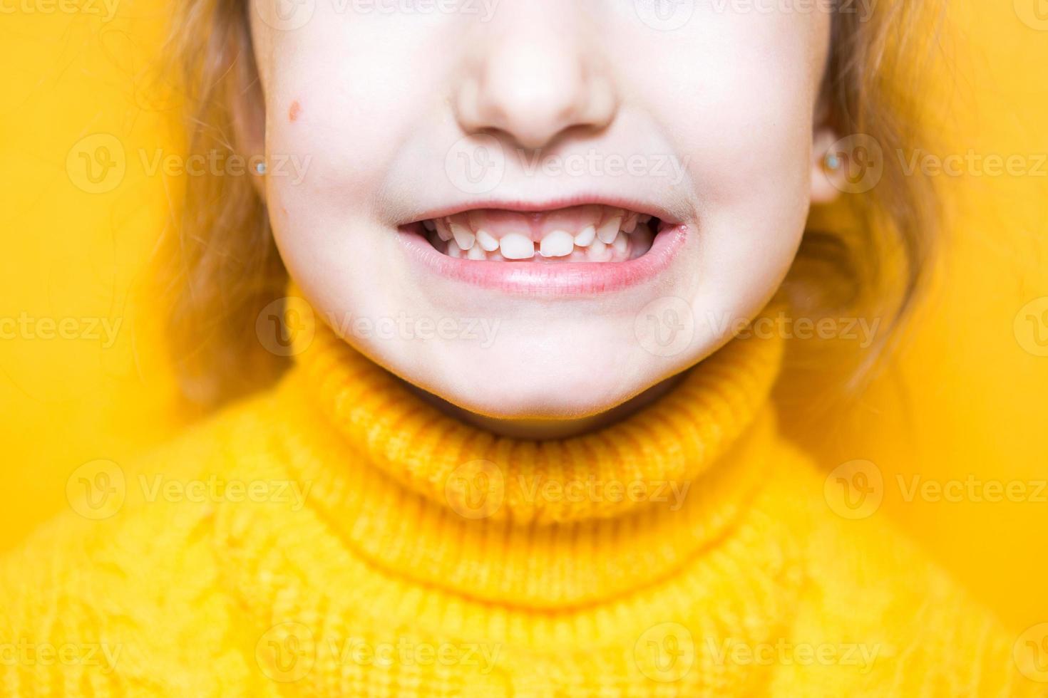la niña muestra su mordida patológica de dientes, maloclusión, sobremordida. odontopediatría y periodoncia, corrección de mordida. salud y cuidado de los dientes, tratamiento de caries, dientes de leche. la mandíbula superior descansa sobre la encía. foto