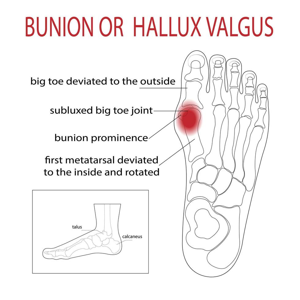 Bursitis on the sides of the foot. The bone and skin on the sides of the big toe joint form an abnormal foot shape. Common problem. vector