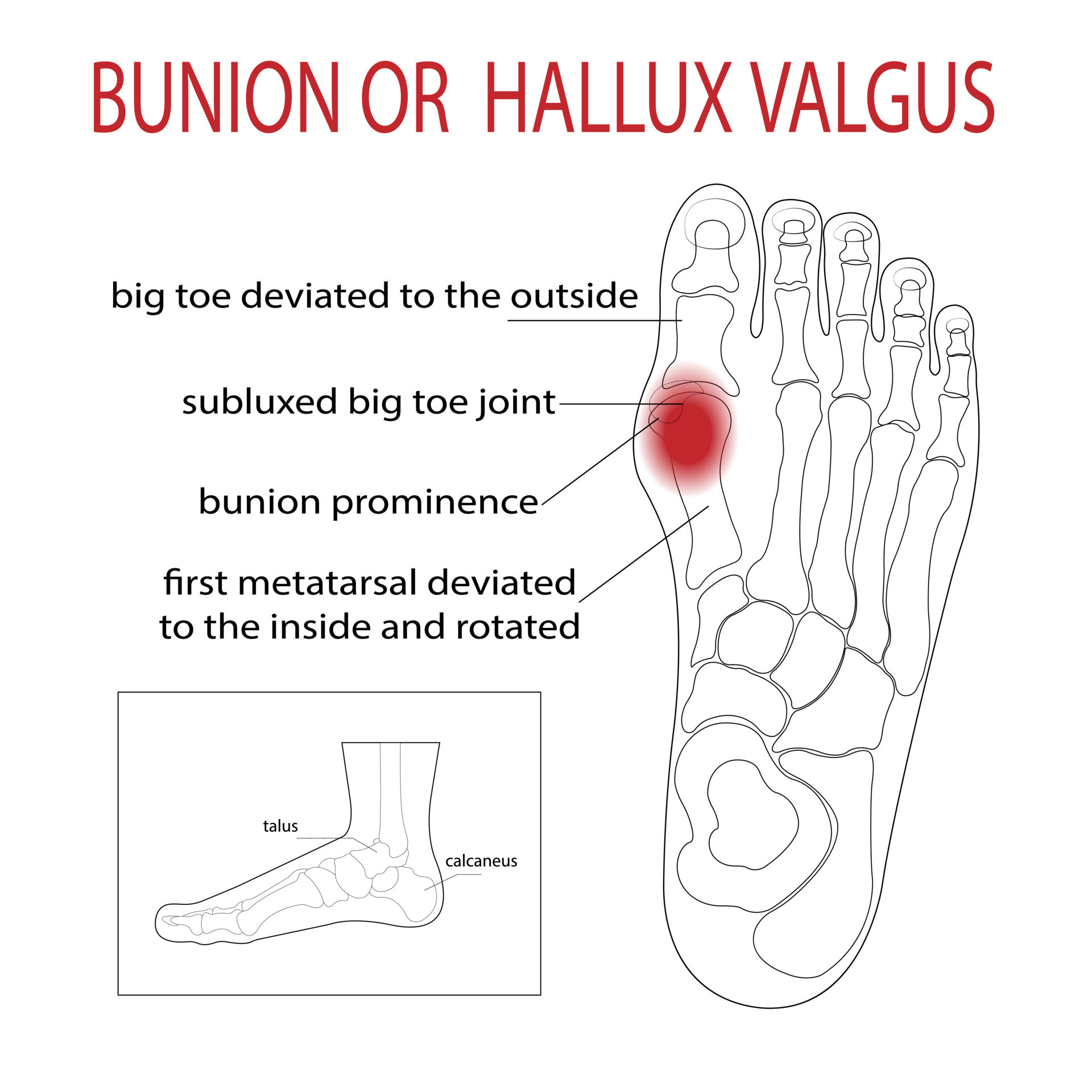 Bursitis on the sides of the foot. The bone and skin on the sides of