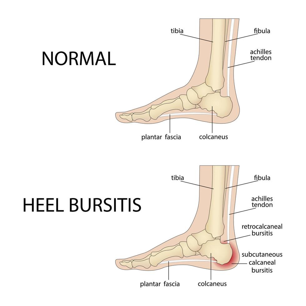 Calcaneal bursitis. Foot with normal heel and foot with Haglund's deformity and bursitis. vector