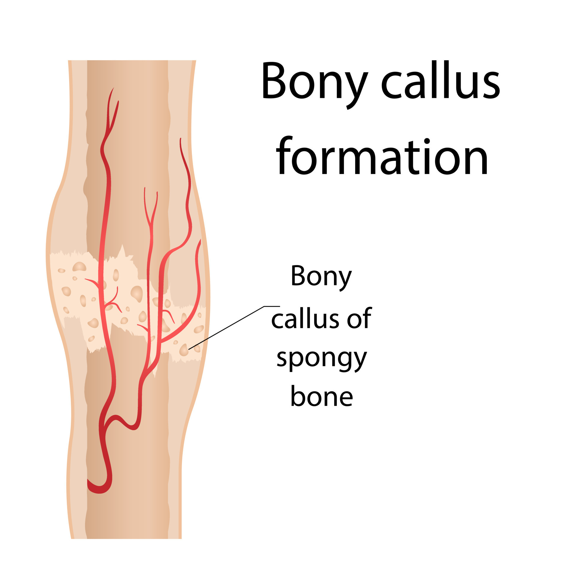 Stage of healing of bone fractures. callus formation. Hematoma. Crack in the bone. Infographics