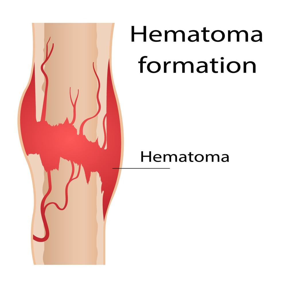 Stage of healing of bone fractures. callus formation. Hematoma. Crack in the bone. Infographics. Final illustration on isolated background. vector