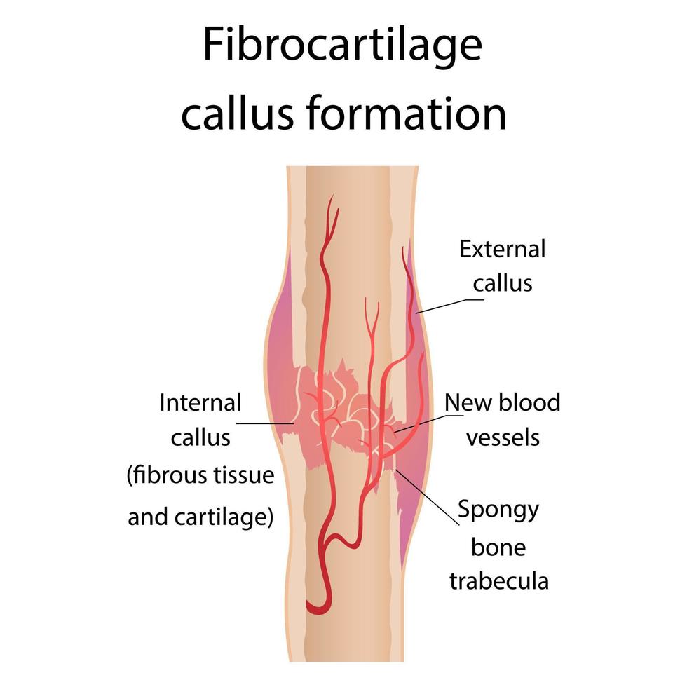 Stage of healing of bone fractures. callus formation. Hematoma. Crack in the bone. Infographics. Final illustration on isolated background. vector