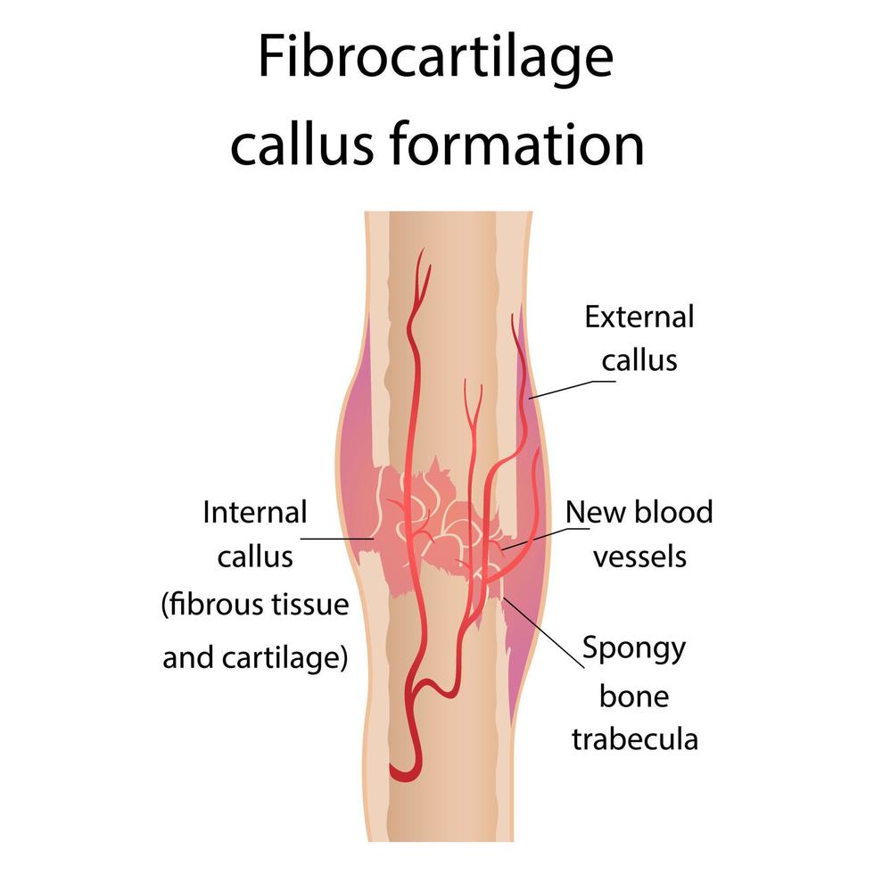 Etapa de curación de las fracturas óseas. formación de callos. hematoma. grieta en el hueso. infografía. ilustración final sobre fondo aislado. vector