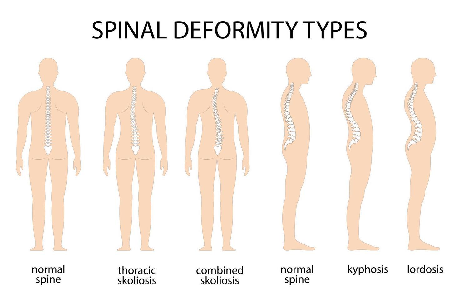 Spine deformity vector illustration. Kyphosis, lordosis spine infographic. Diagram with spine curvature and healthy spine. Posture defect. Medical, educational and scientific banner.