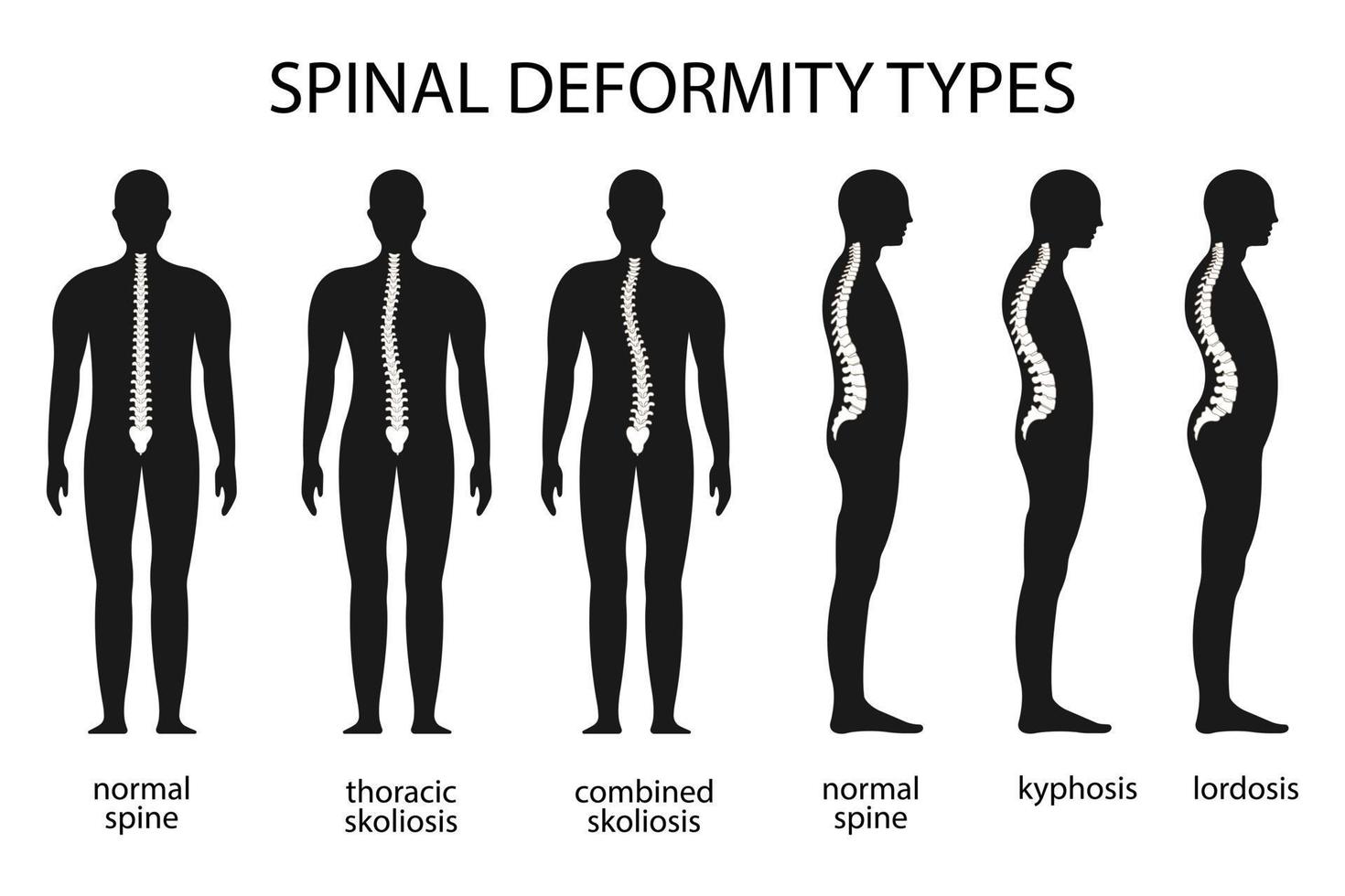 Spine deformity vector illustration. Kyphosis, lordosis spine infographic. Diagram with spine curvature and healthy spine. Posture defect. Medical, educational and scientific banner.