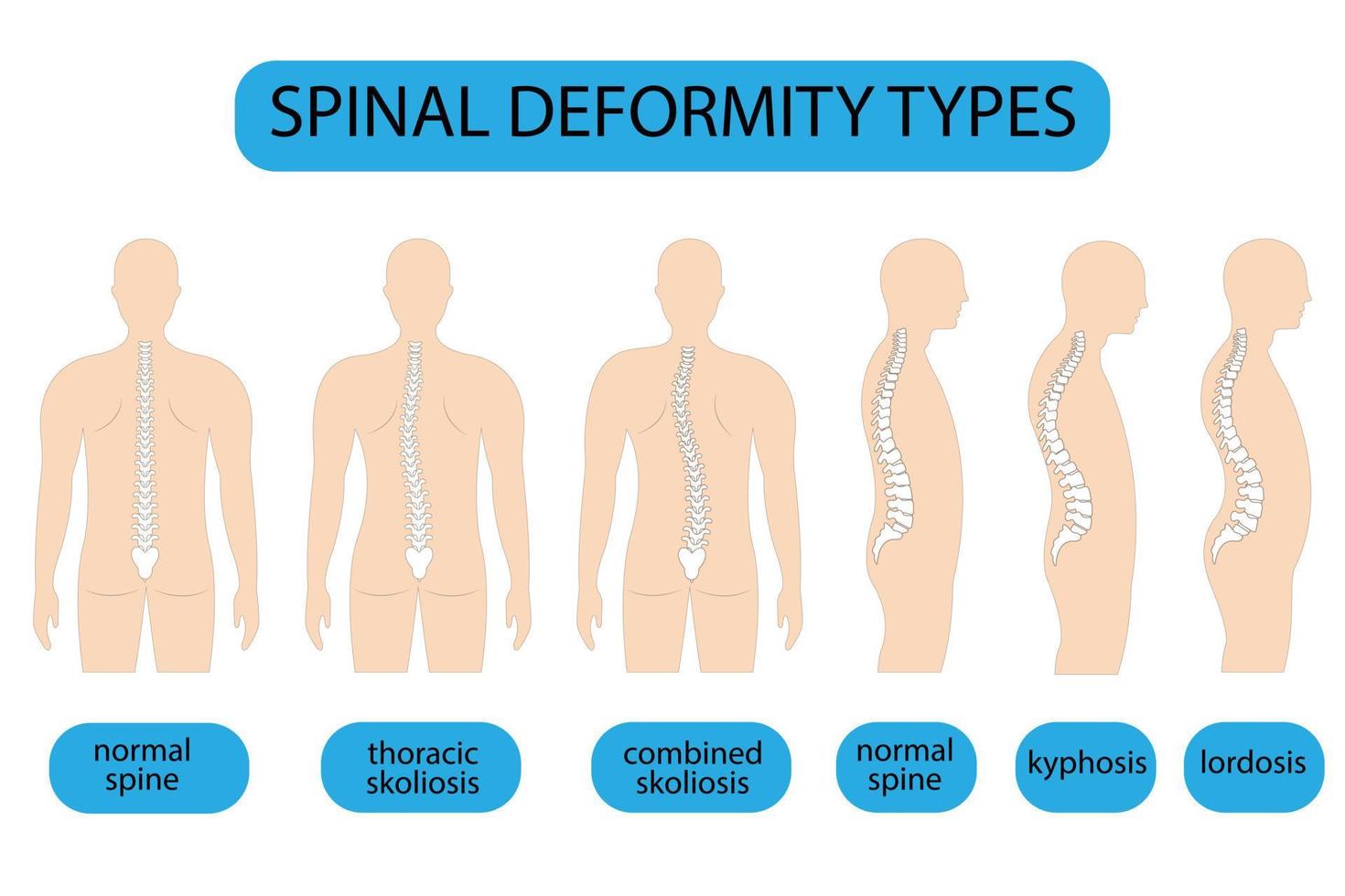 ilustración vectorial de deformidad de la columna vertebral. cifosis, columna infográfica de lordosis. diagrama con curvatura de la columna vertebral y columna sana. defecto de postura estandarte médico, educativo y científico. vector