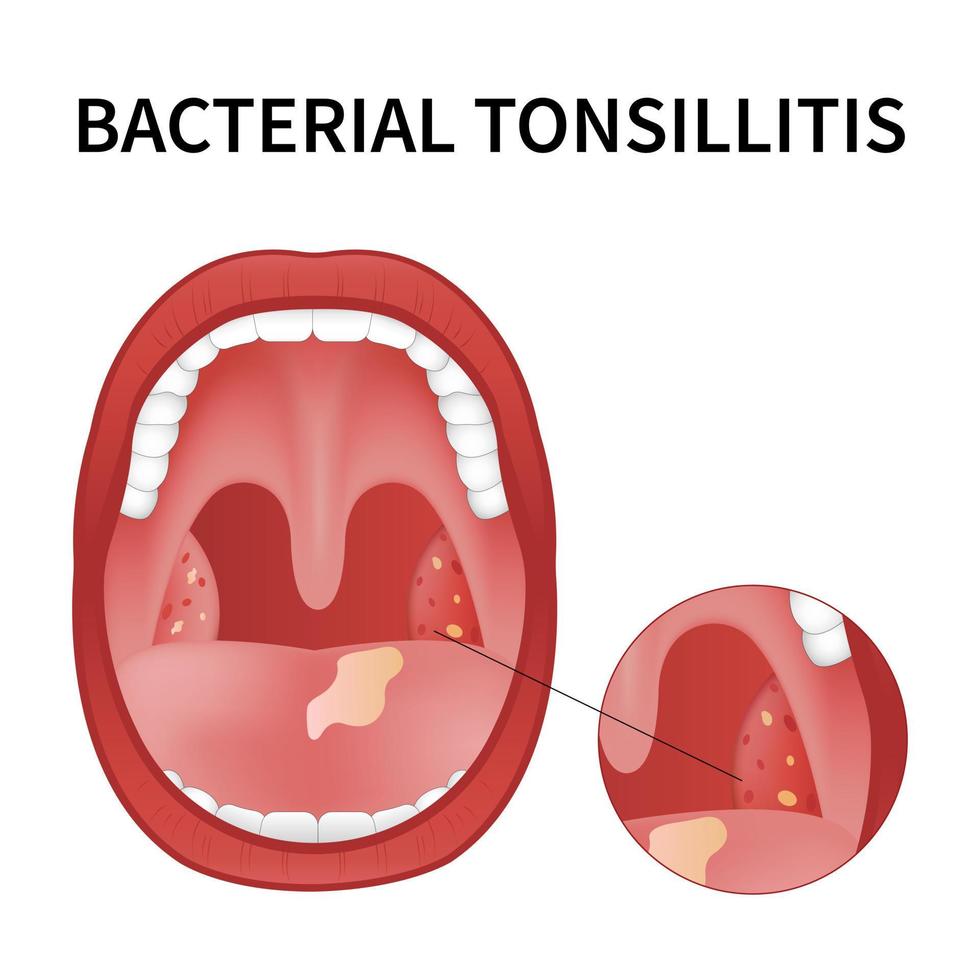 Bacterial and viral tonsillitis. Angina, pharyngitis, and tonsillitis. Tonsil infection. Open Mouth. vector