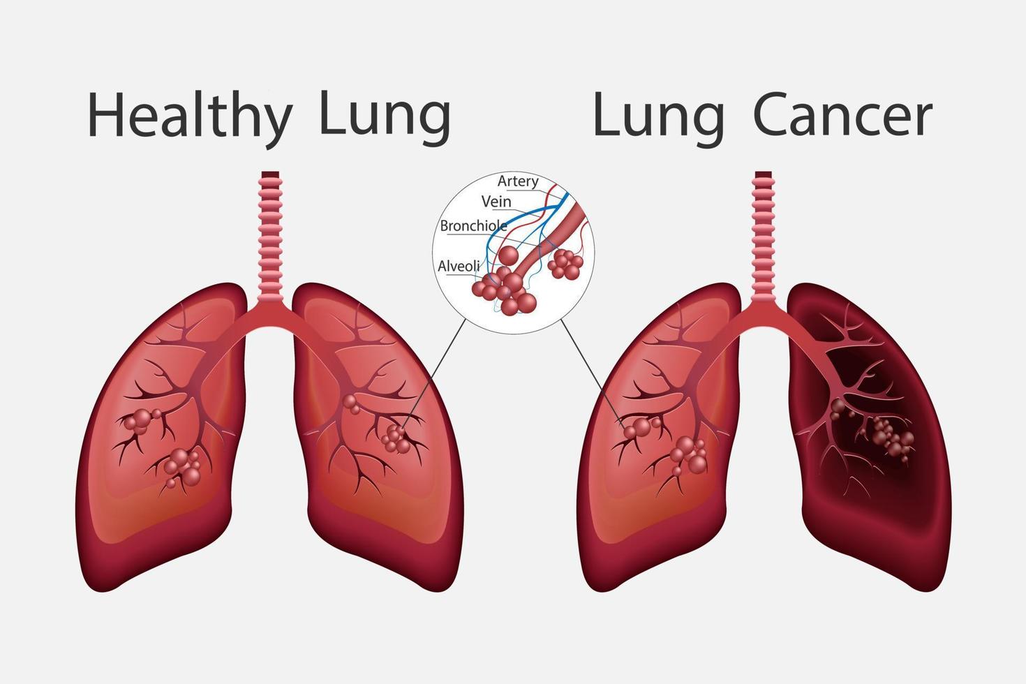 Healthy and unhealthy human lungs. Normal lung versus lung cancer. Human organ icon. Vector illustration.