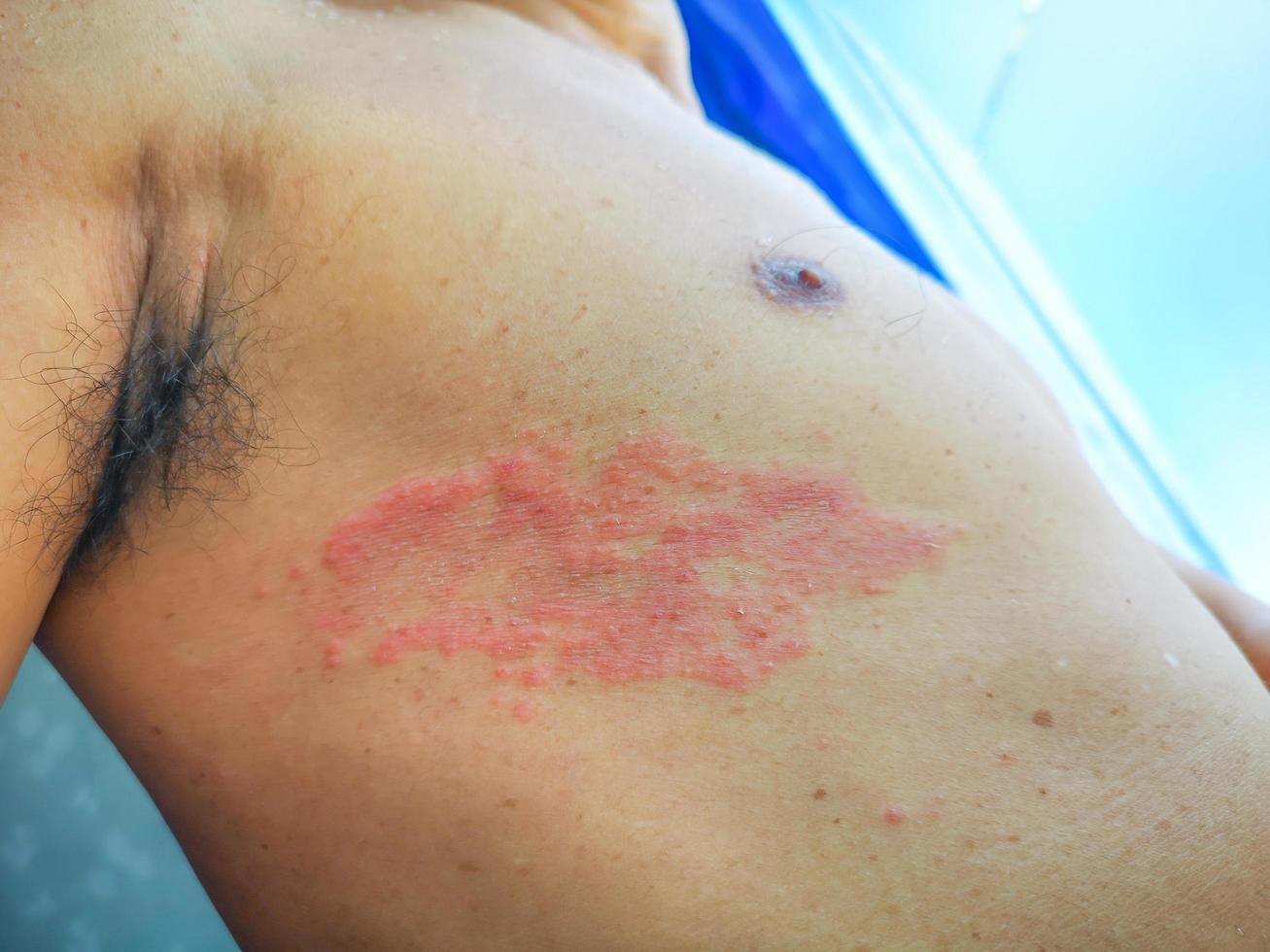 Painful back skin rash with blisters in a limited area.A man who had varicella blister, chickenpox, Herpes zoster, or Shingles. photo