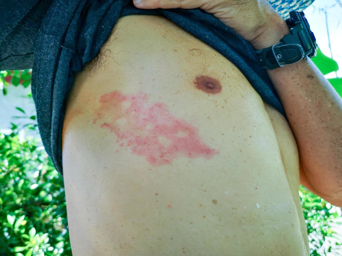 Painful back skin rash with blisters in a limited area.A man who had varicella blister, chickenpox, Herpes zoster, or Shingles. photo