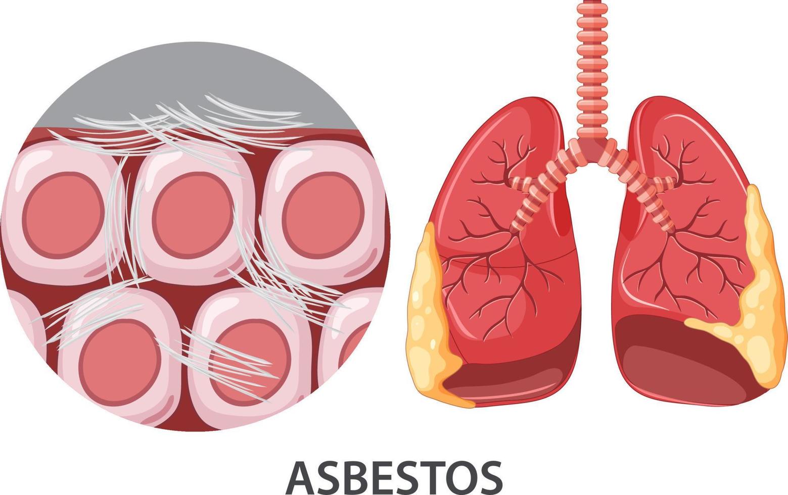 Asbestosis on human lungs vector