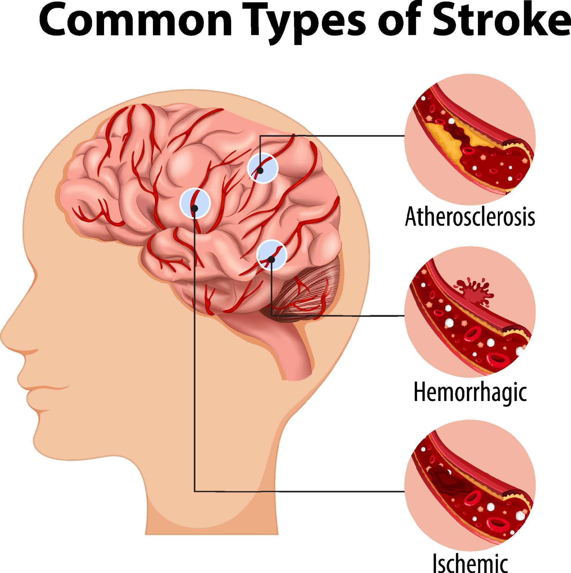 Human With Common Types Of Stroke 8337135 Vector Art At Vecteezy human-with-common-types-of-stroke-8337135-vector-art-at-vecteezy