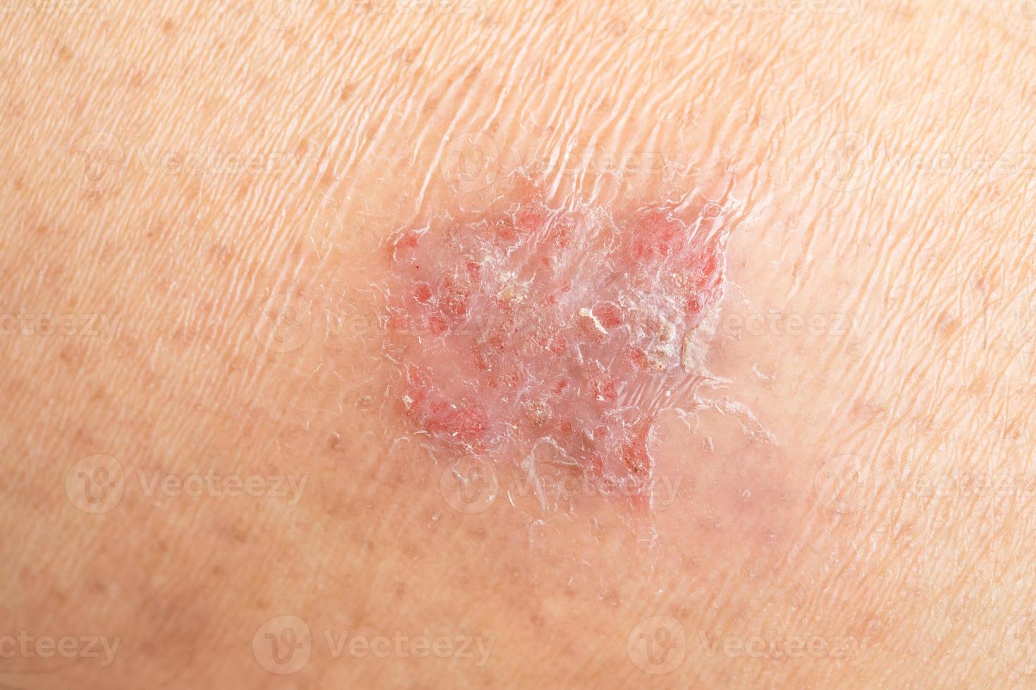 enfermedad dermatológica de la piel en la piel humana foto