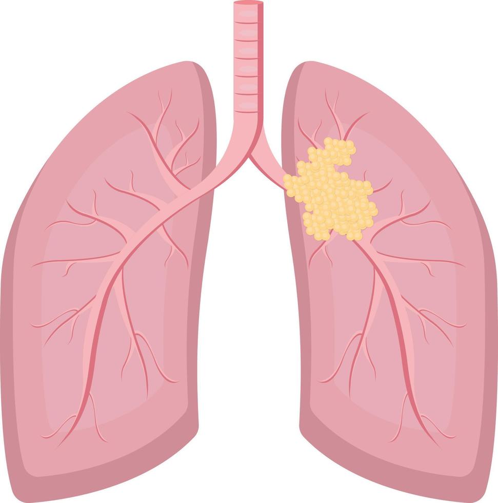 cáncer de pulmón aislado sobre fondo blanco vector