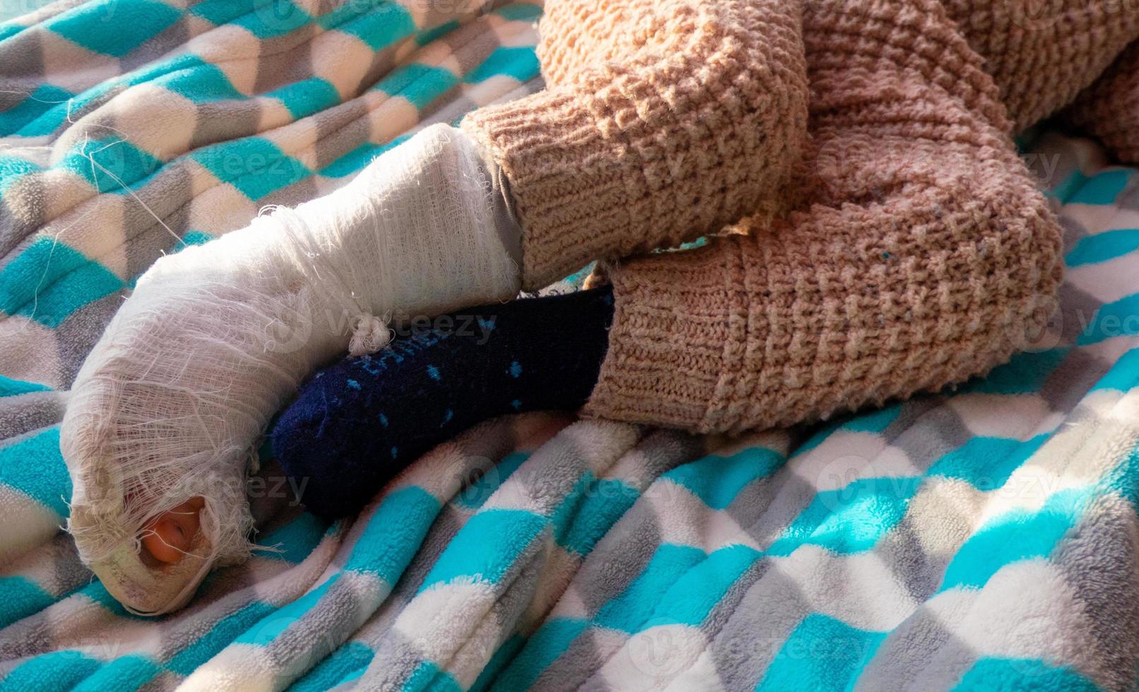 Child with bandage on leg heel fracture. Broken right foot, splint of toddler. Little boy sleeping on a blue blanket. photo