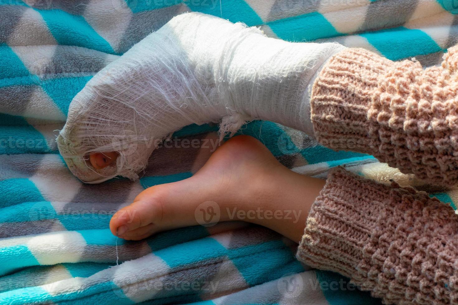 Child with bandage on leg heel fracture. Broken right foot, splint of toddler. Little boi sleeping on a blue blanket. photo