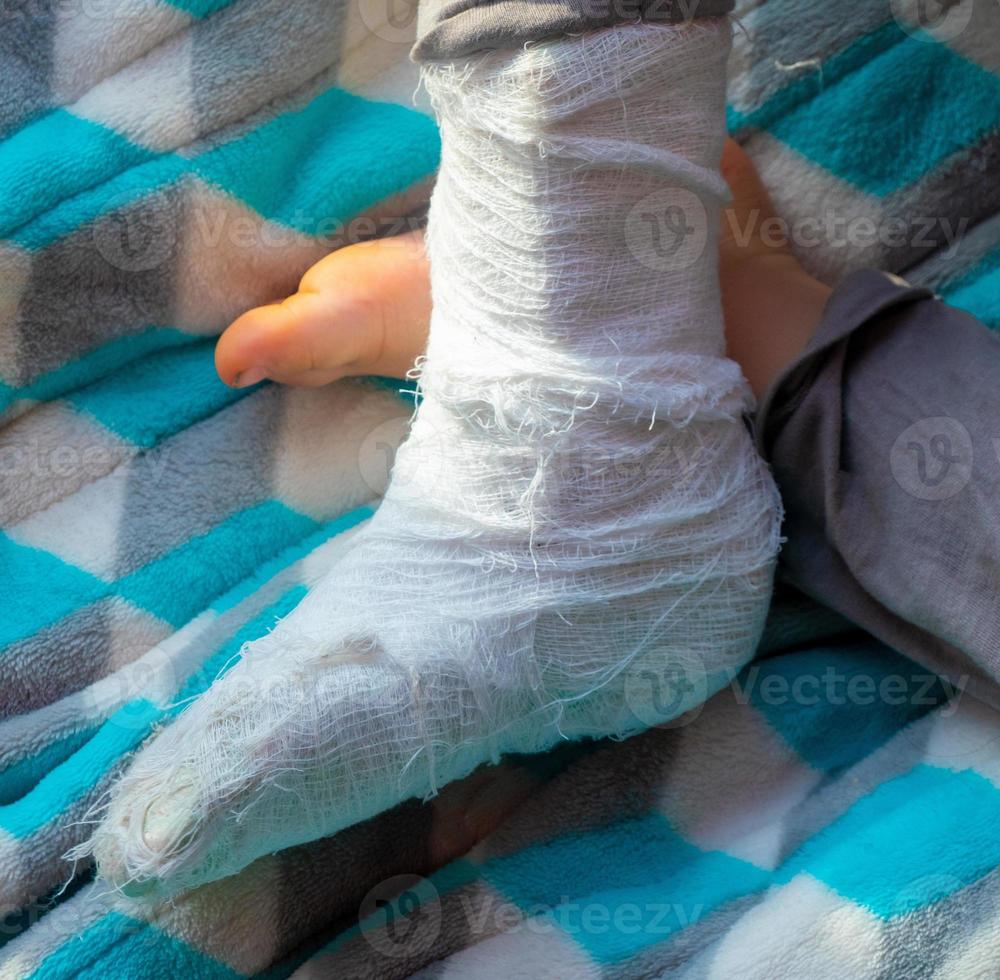 Child with bandage on leg heel fracture. Broken right foot, splint of toddler. Little boi sleeping on a blue blanket. photo