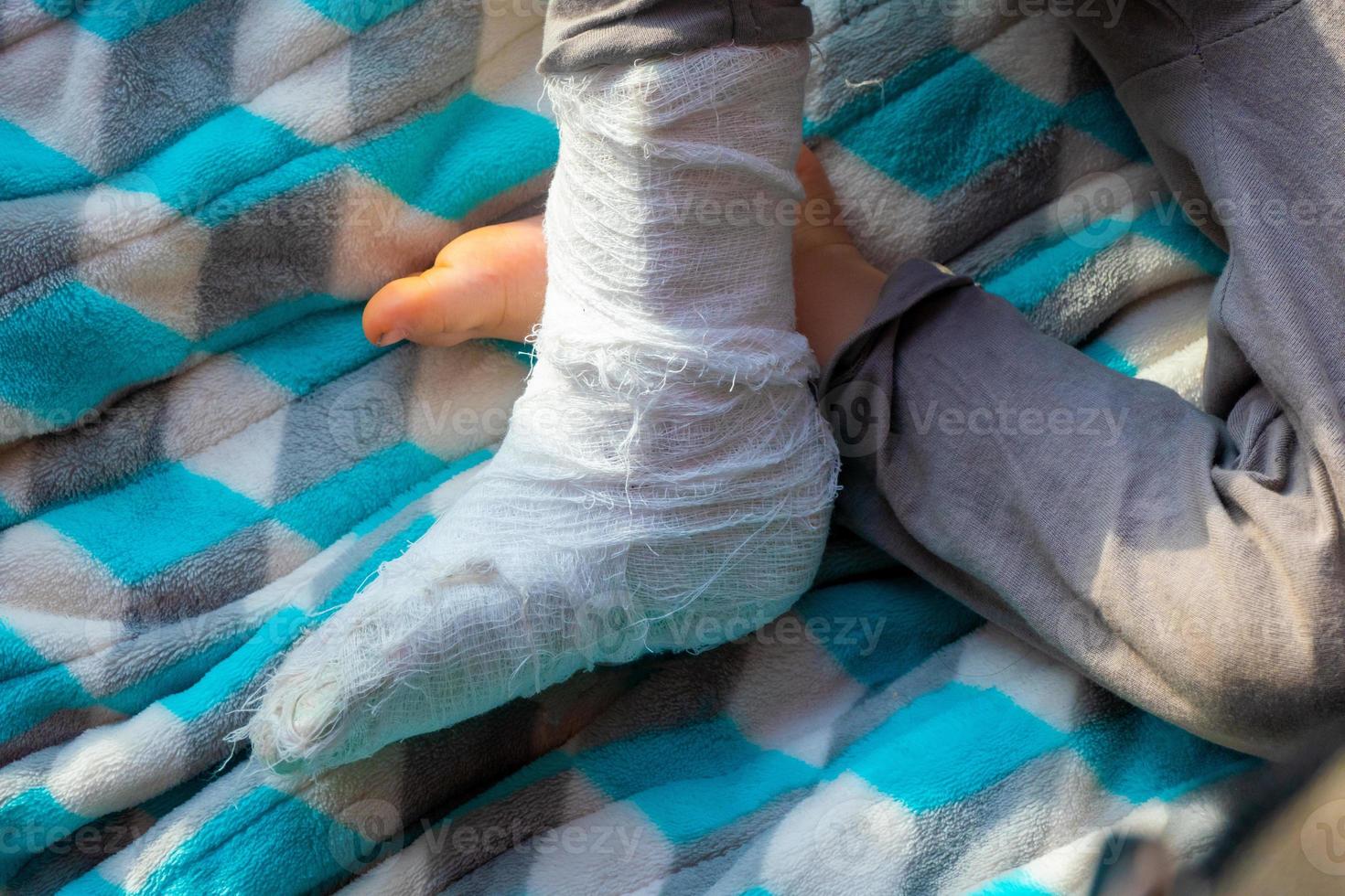 Child with bandage on leg heel fracture. Broken right foot, splint of toddler. Little boi sleeping on a blue blanket. photo