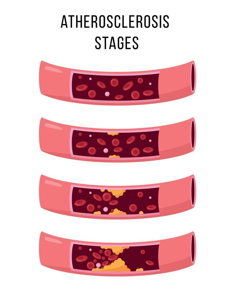 etapas de aterosclerosis ilustración vectorial sobre fondo blanco. arterias sanas y no sanas. funciones normales, disfunción del endotelio, formación de placa, trombosis por ruptura. vector