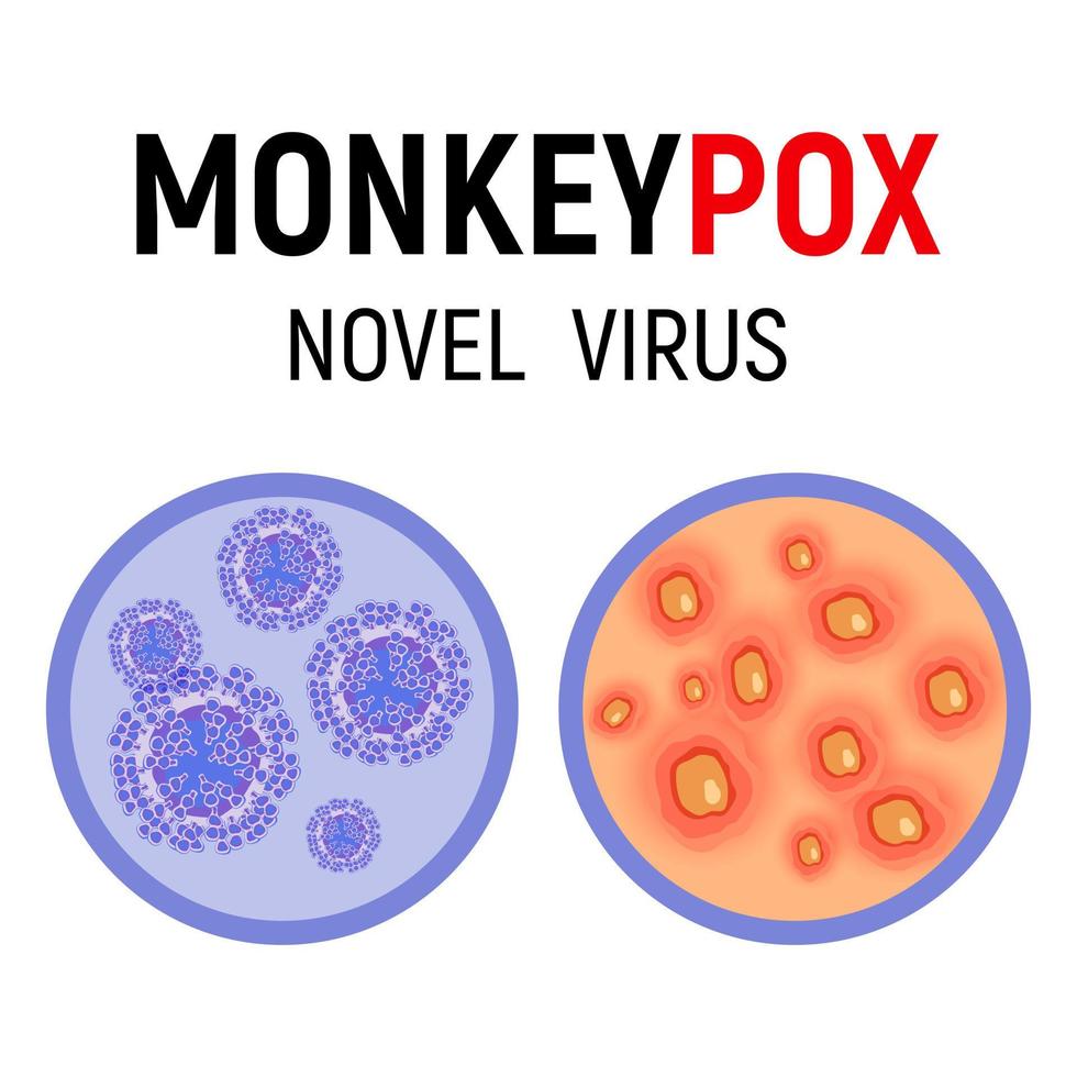 Monkeypox virus cells and human skin with rash, wounds and ulcers on a white background close-up. Monkeypox virus symptom. Vector illustration.