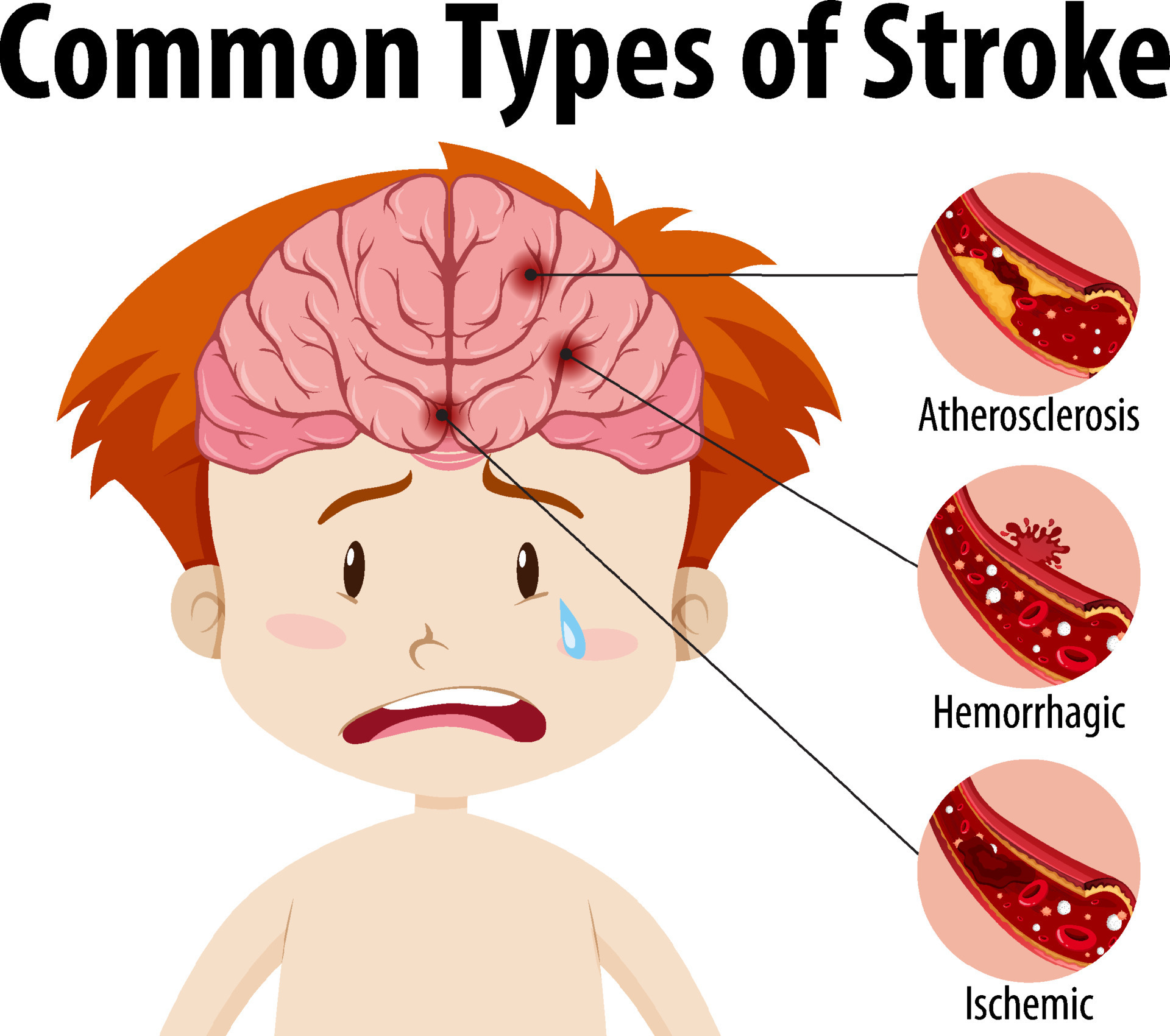 Human With Common Types Of Stroke 8386860 Vector Art At Vecteezy human-with-common-types-of-stroke-8386860-vector-art-at-vecteezy