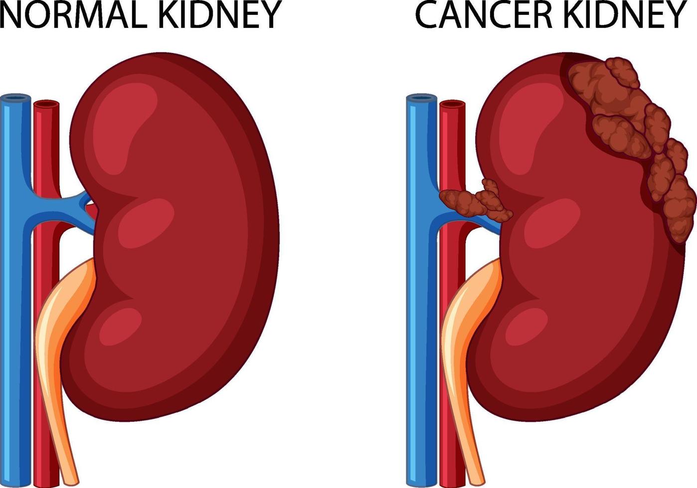 Normal kidney and cancer kidney vector