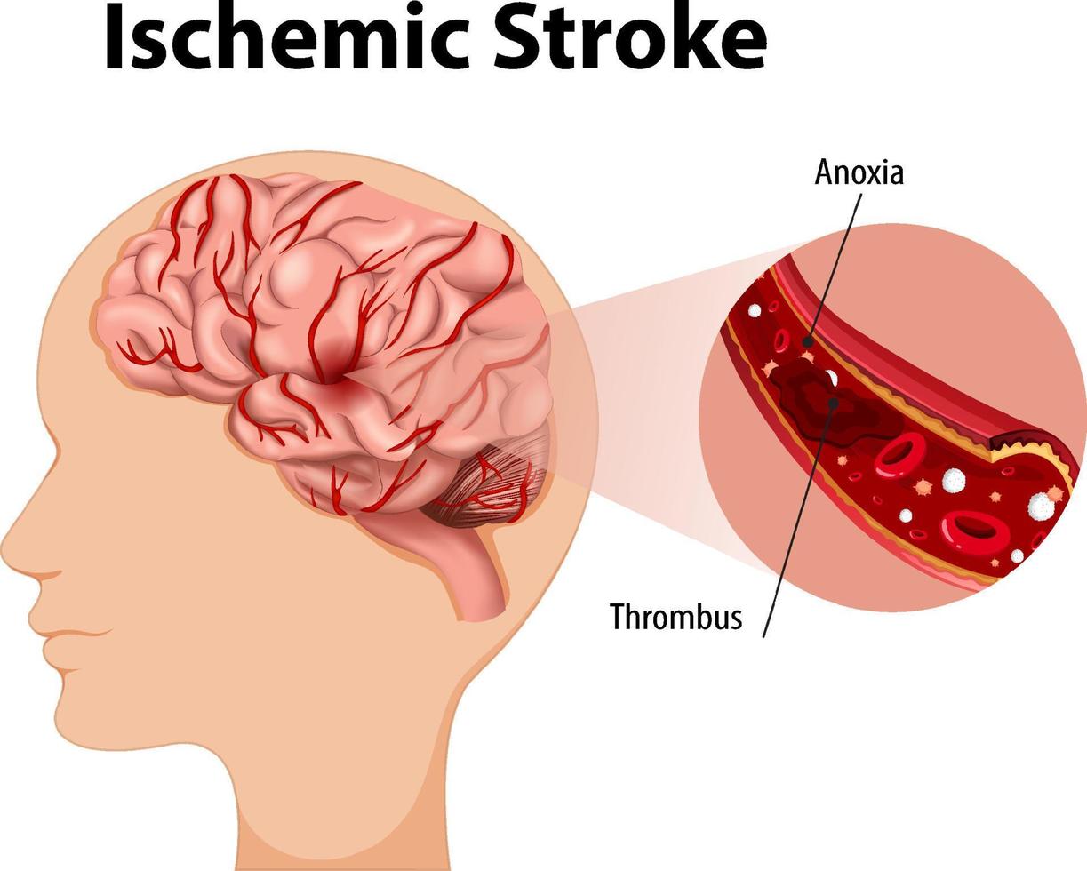 Human with Ischemic stroke vector