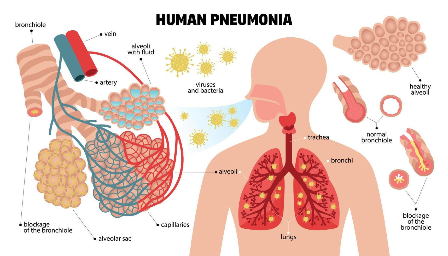Human Pneumonia Infographic Set vector