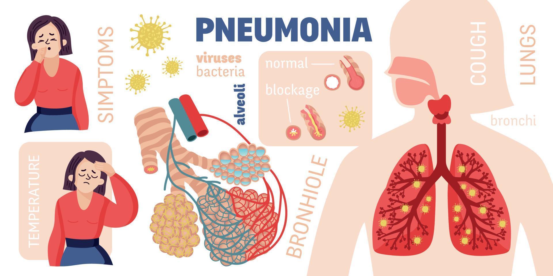 infografía de dibujos animados de neumonía humana vector