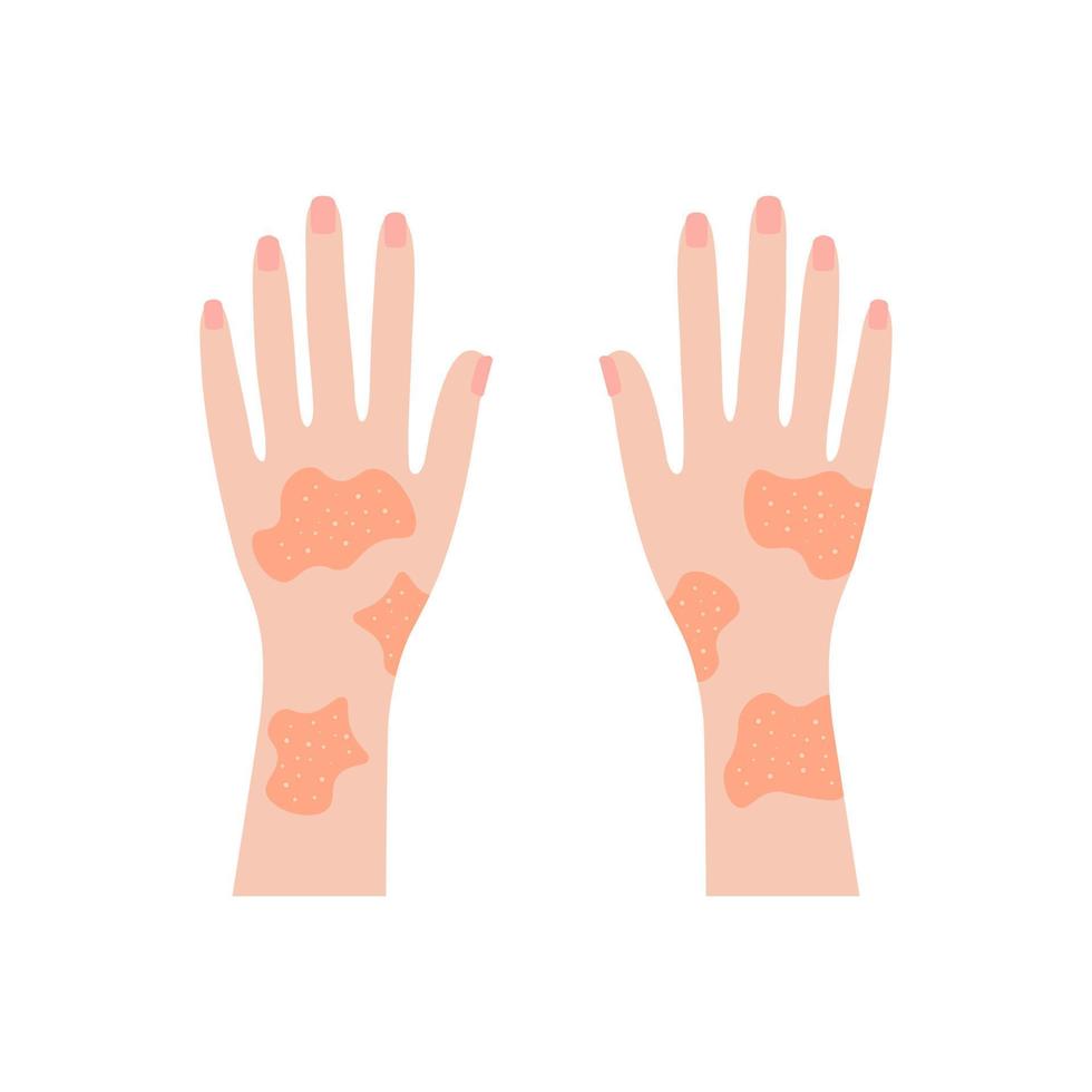 Hands covered with rash. Red psoriatic eruptions and inflamed eczema. Allergic urticaria problems and infectious vector smallpox infection