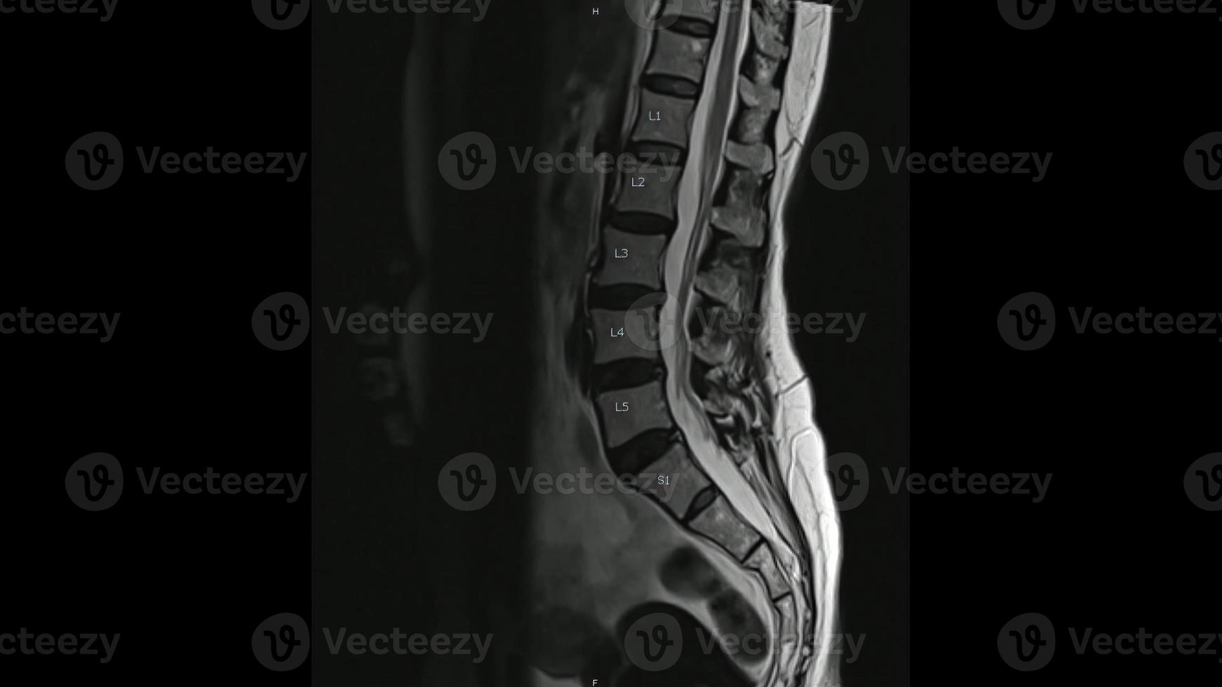 Magnetic Resonance images of Lumbar spine sagittal T2-weighted images  ,MRI Lumbar spine, showing mild disc disease. photo