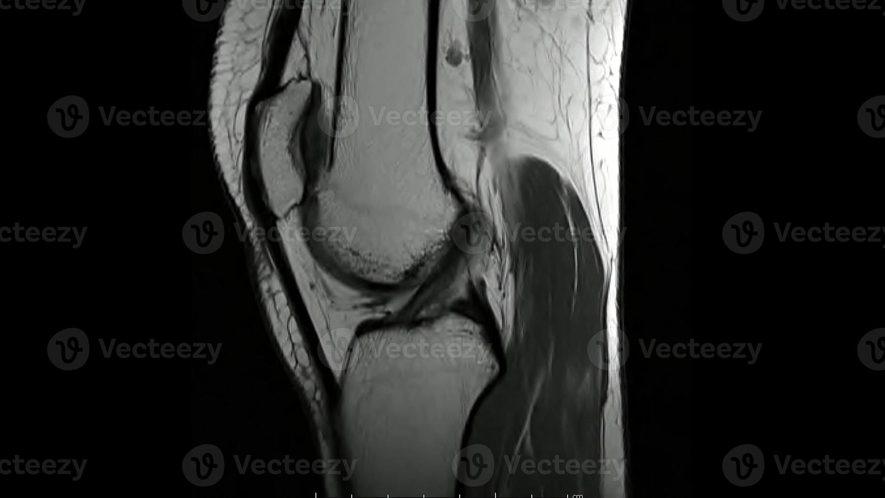 Magnetic Resonance images of  The Knee joint Sagittal T1- weighted Images ,MRI Knee joint, showing the anatomy of the knee photo