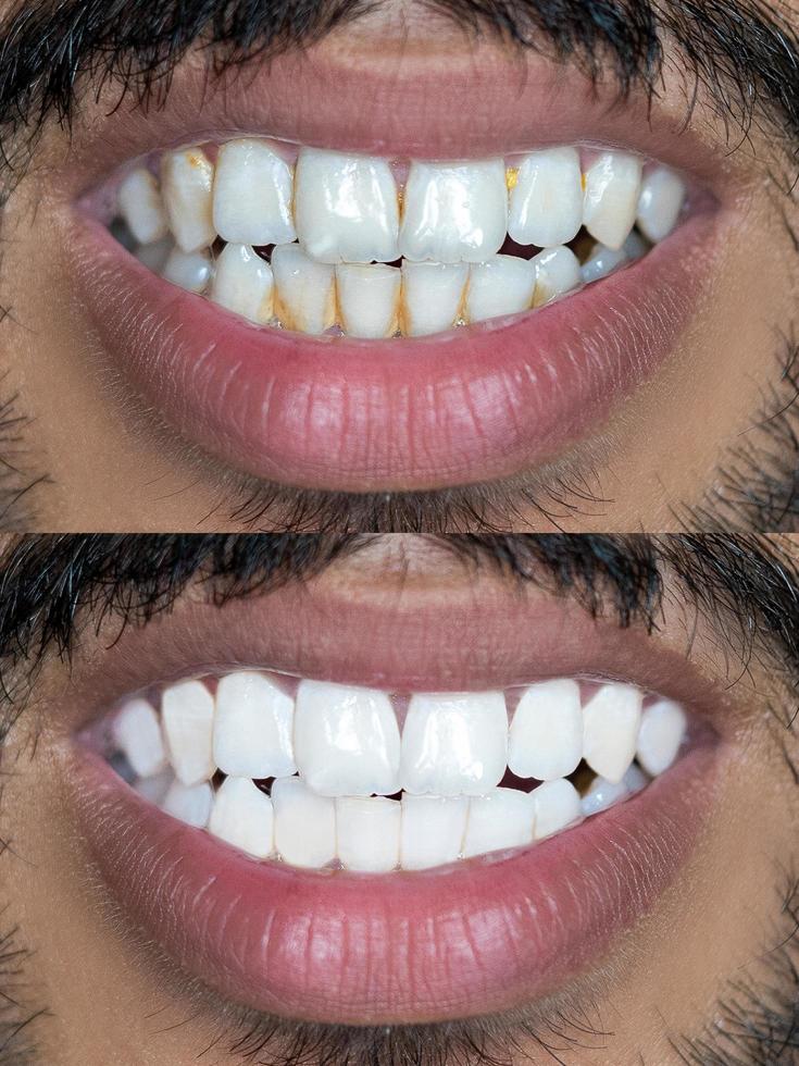 dientes antes y después del blanqueamiento. concepto de cuidado dental foto