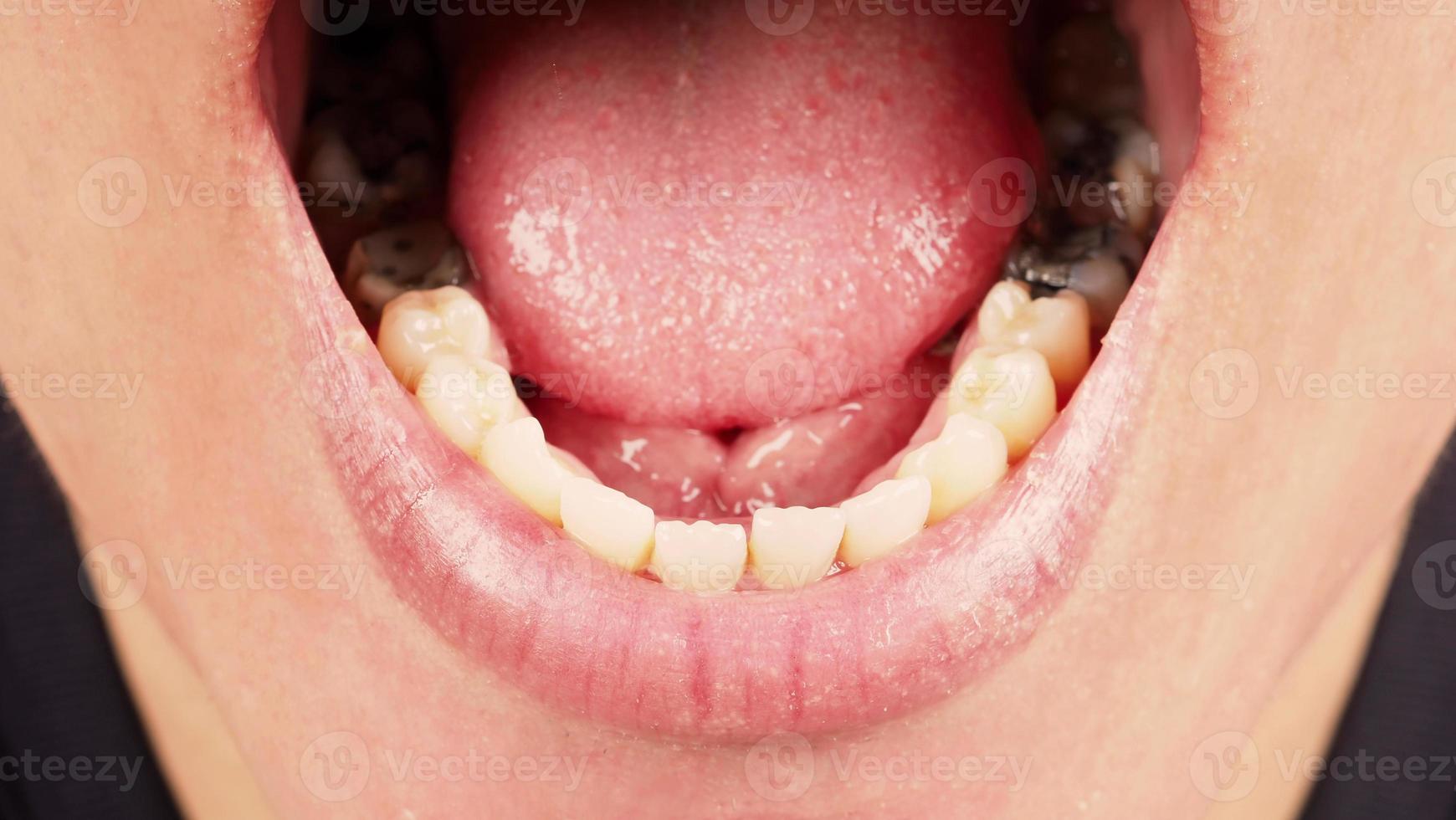 Tratamiento de conductos radiculares de dientes cariados. Diente o caries dental del molar inferior. foto