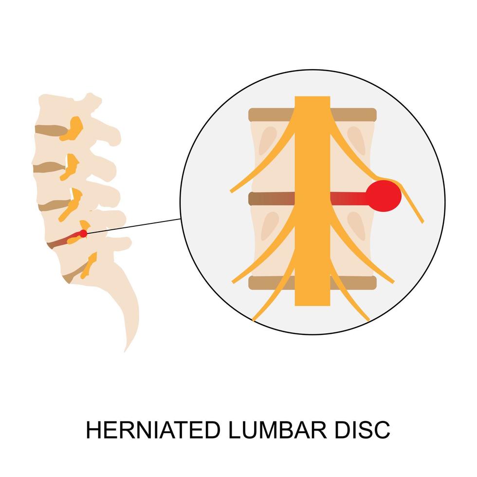 demostración ilustrativa del disco lumbar herniado humano vector