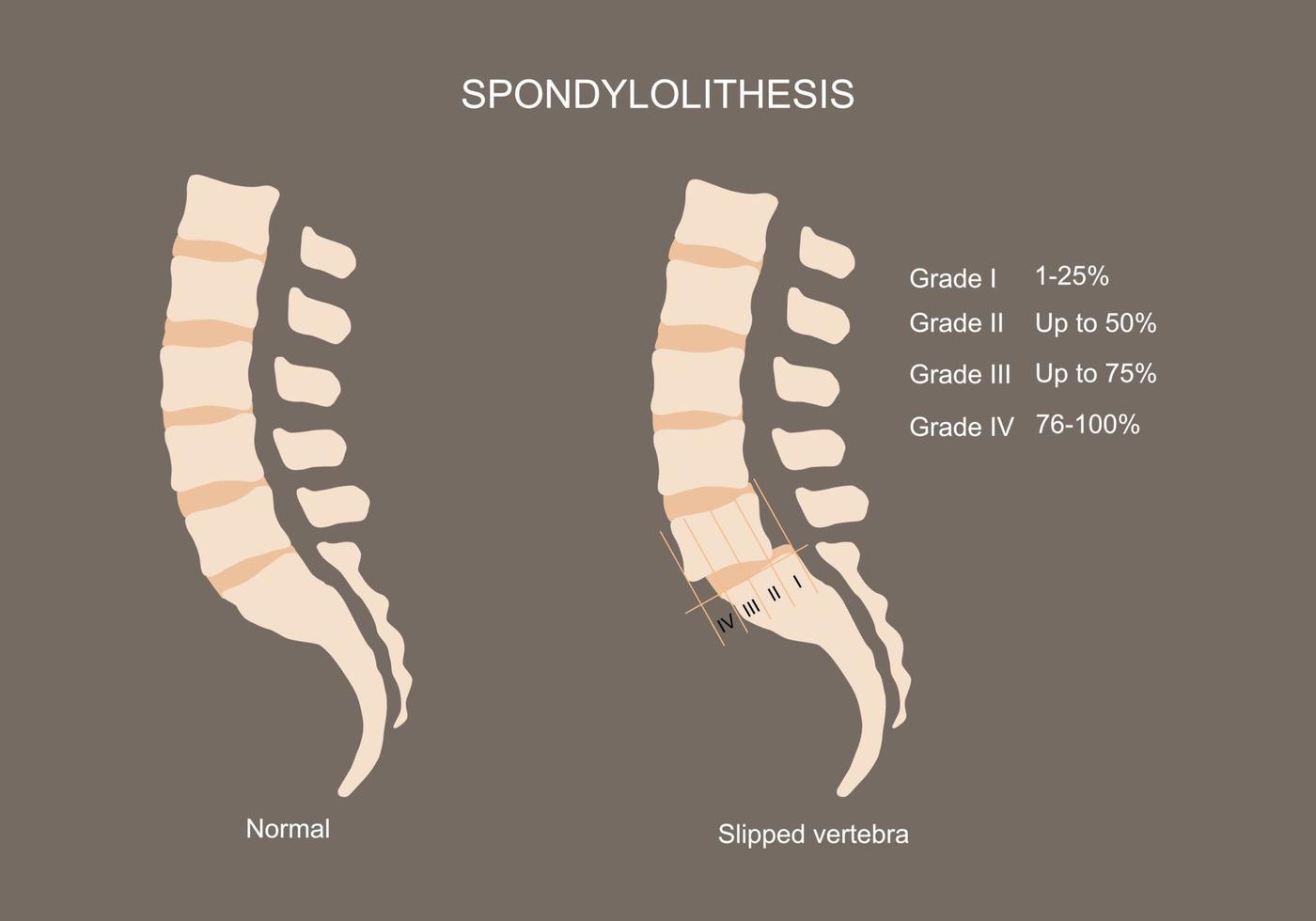 Vector illustration of lumbar spine and spondylolithesis