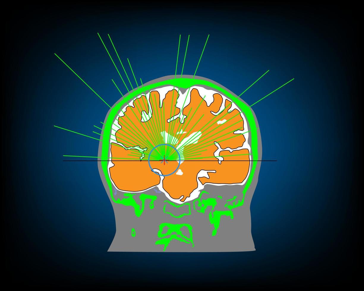 ultrasonido enfocado de alta intensidad dirigido al cerebro humano vector