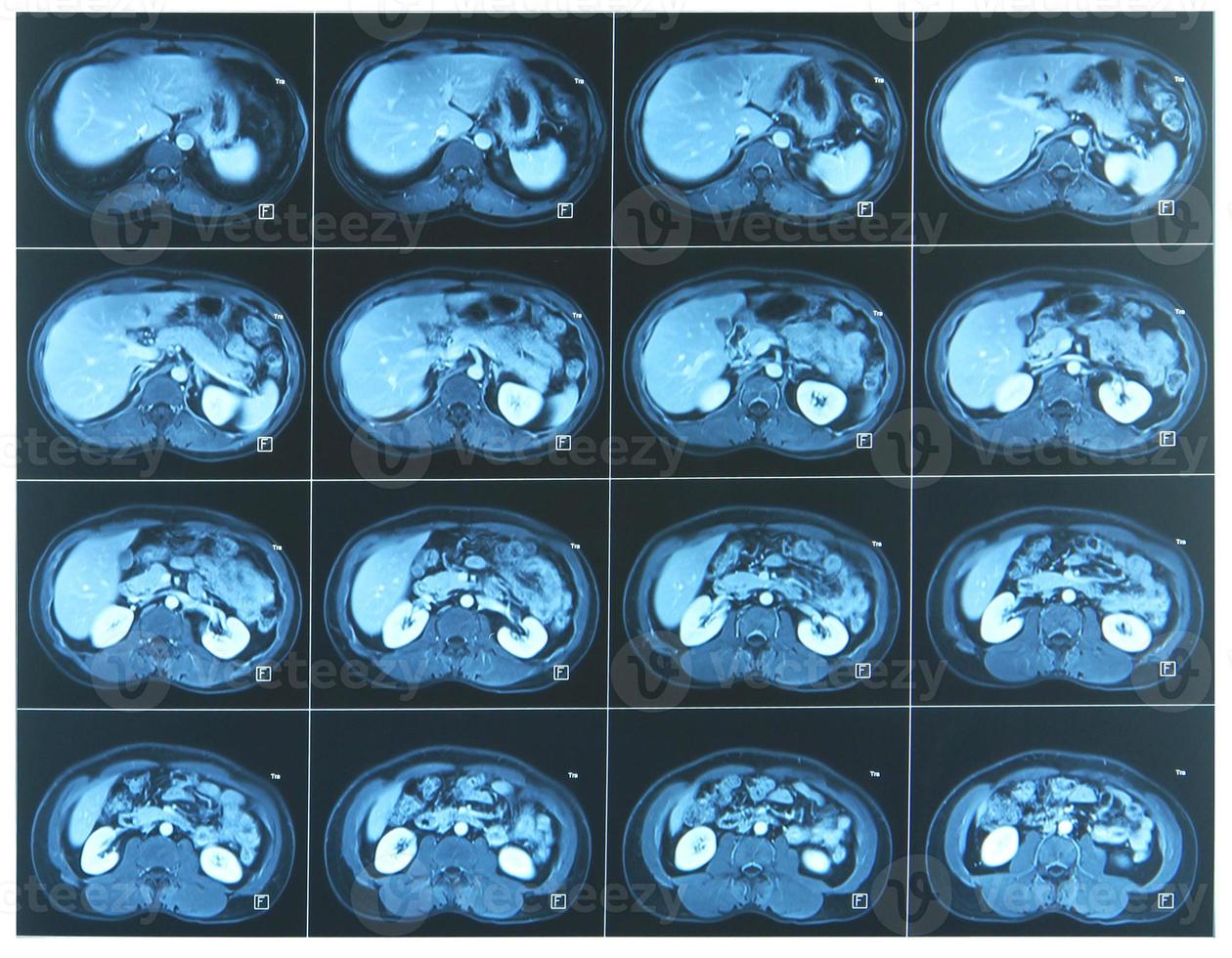 Abdomen MRI scan photo
