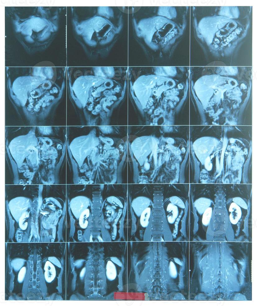 Abdomen MRI scan photo